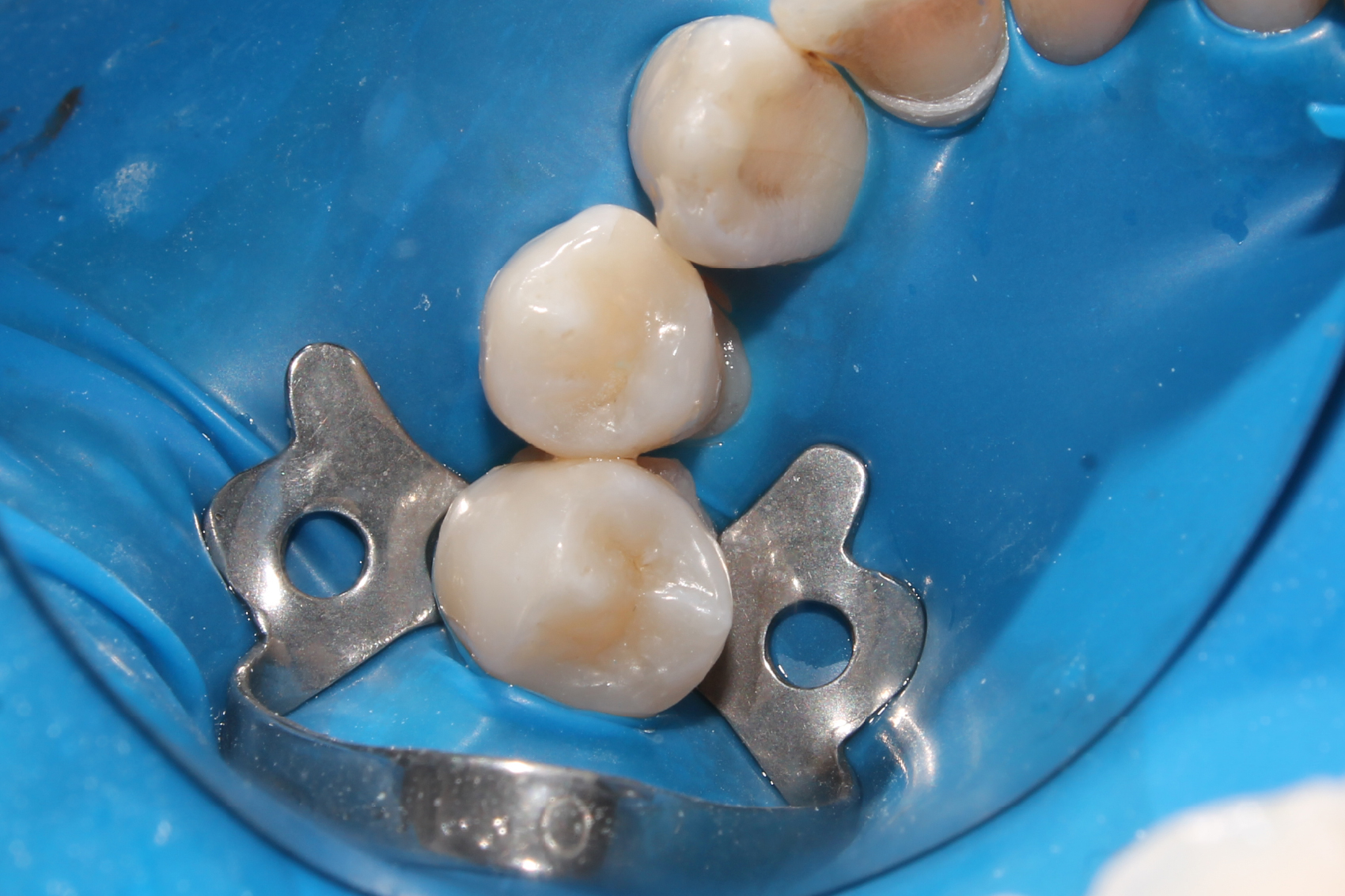 Implantes dentales